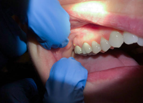 Best Emergency Wisdom Teeth Removal in Pine City, MN